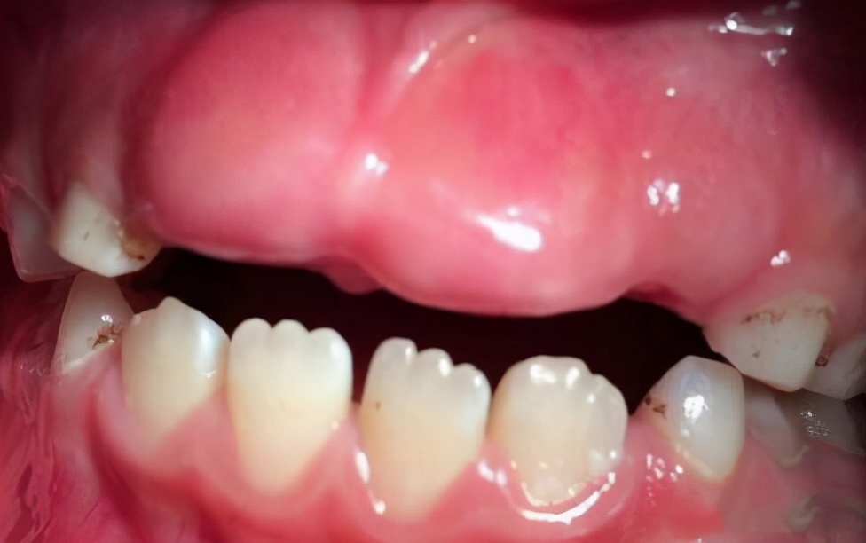 7岁小孩门牙掉了一年没长怎么办,7岁小孩门牙掉了一直不长怎么办