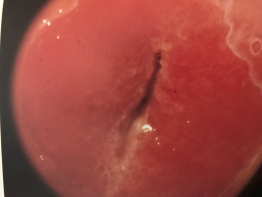 宫颈糜烂算不算病,宫颈糜烂三度算不算病