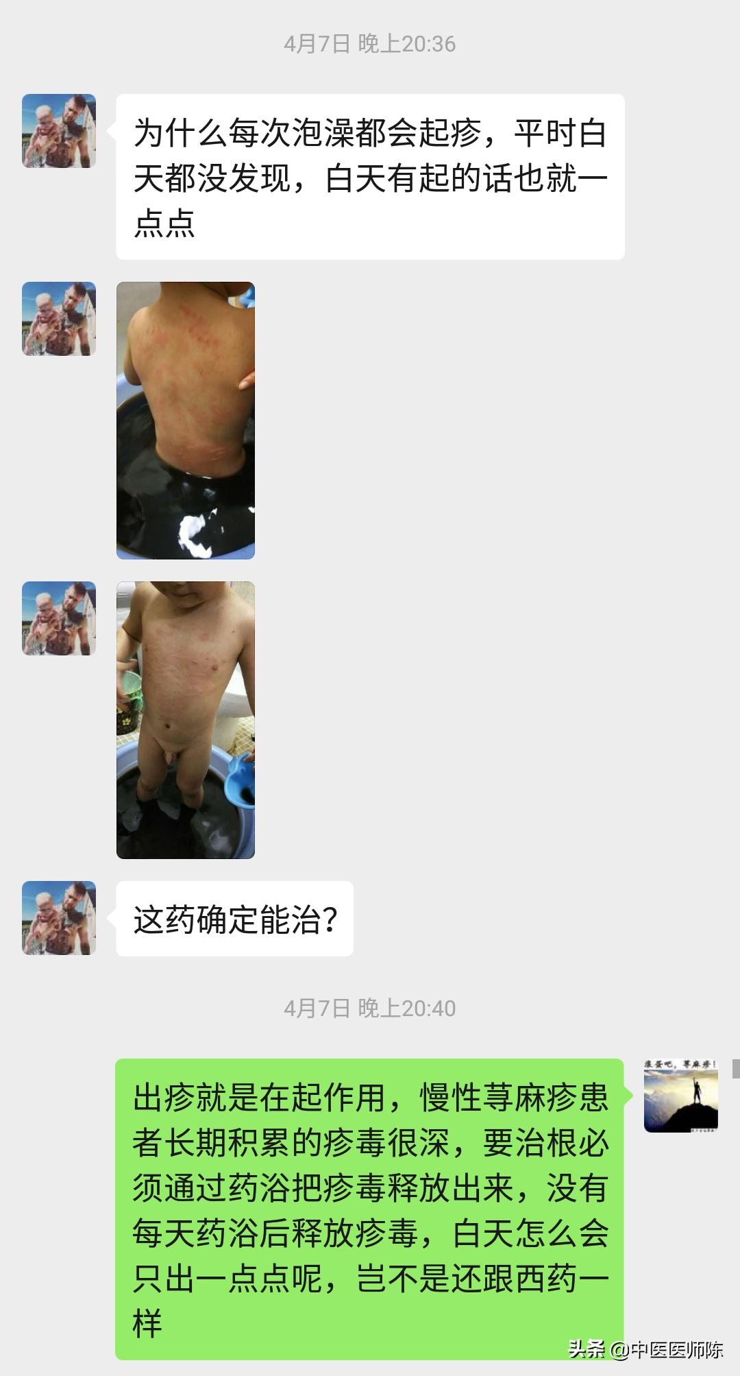 儿童慢性荨麻疹不治疗会自愈吗,儿童慢性荨麻疹治疗不吃药就复发