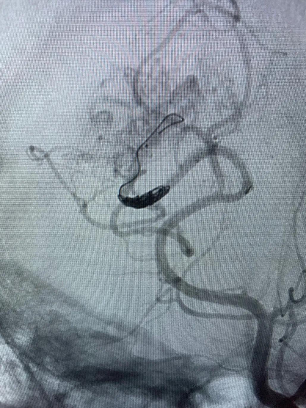 脑动静脉畸形介入栓塞手术的风险,介入栓塞技术在脑avm治疗中的作用