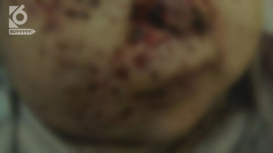 痛心百日女婴惨遭一窝老鼠啃食,三个月大的女婴被老鼠啃后续