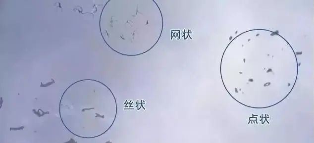 眼前有黑影之飞蚊症