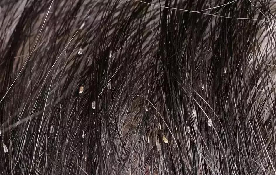 可怕！孩子头发上的白点点，竟然不是头皮屑！