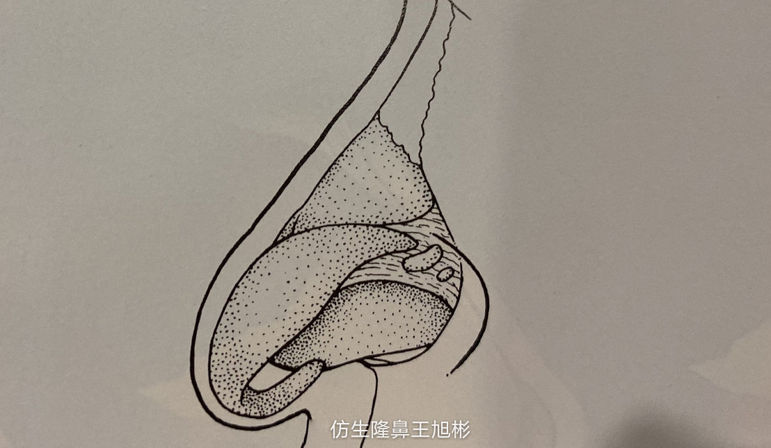 窄鼻子如何通过鼻整形来矫正,宽鼻子矫正方法