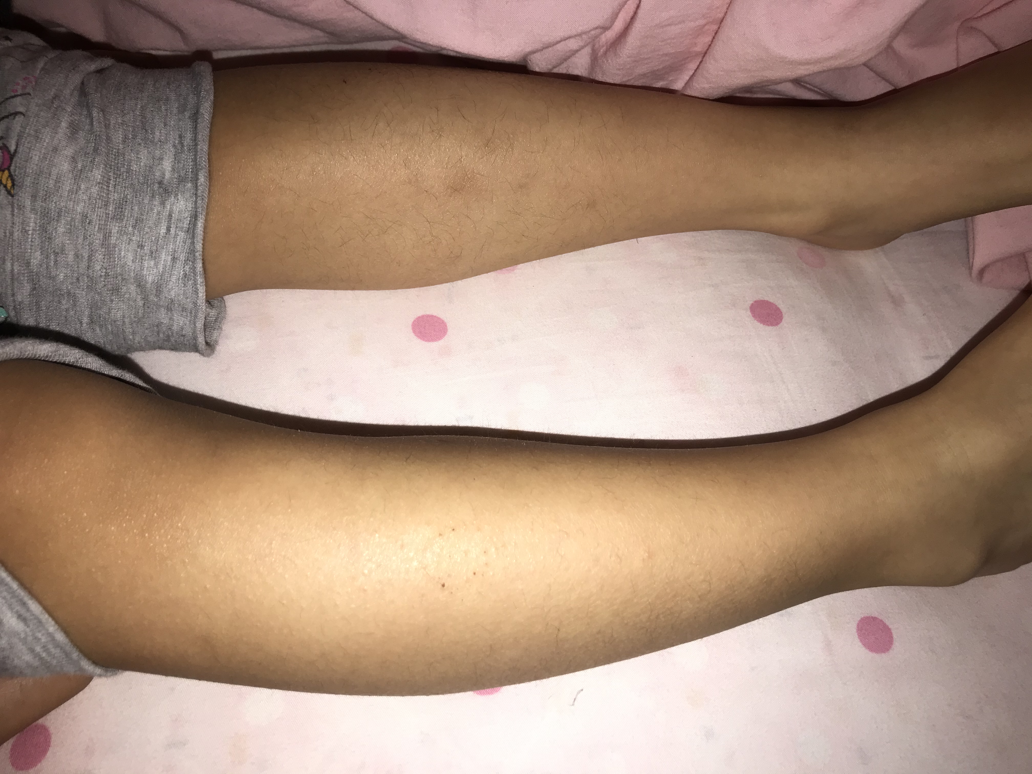 宝宝腿发痒挠破了伤口一直不愈合,宝宝腿很痒怎么快速止痒