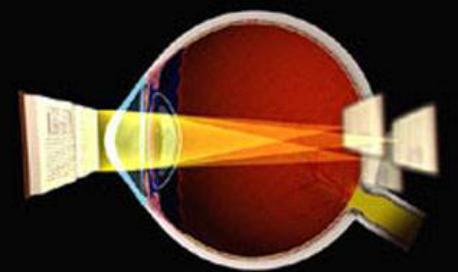 散光100对视力影响大吗,眼睛有散光对视力有什么影响