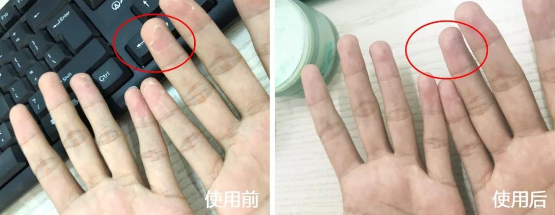 手脚皮肤干裂怎样快速保湿,缓解手脚干裂的小妙招