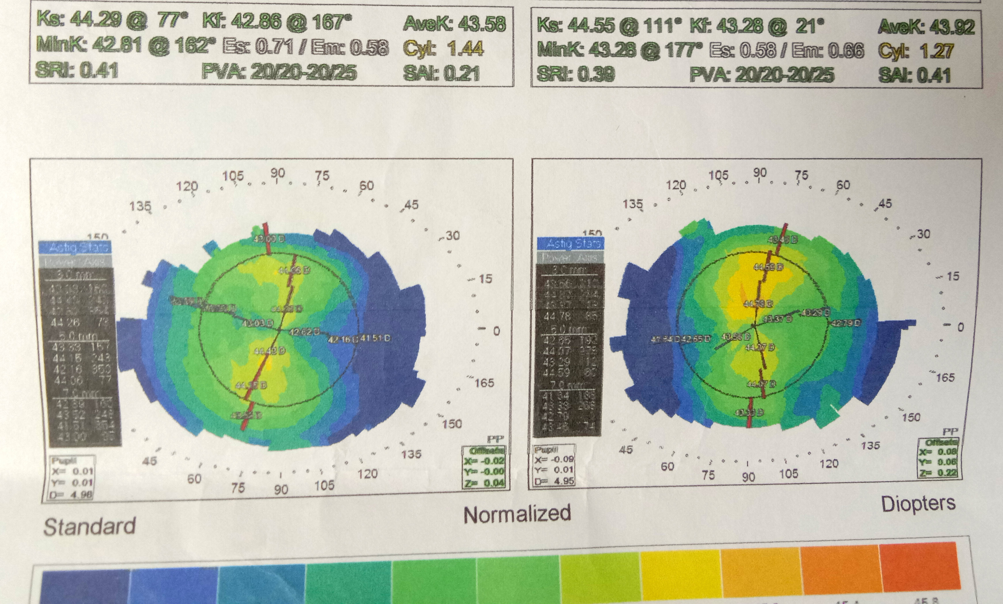 一个近视孩子妈妈的心路历程---角膜塑形镜攻略