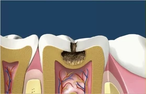 牙菌斑口腔科普,口腔科普牙缝大