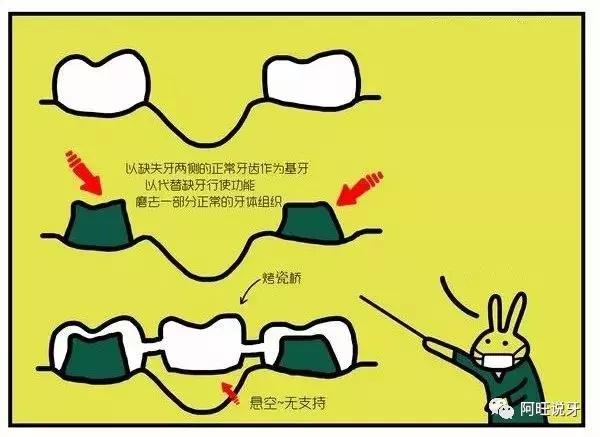 种植牙图片漫画,3d动画2分钟全面了解种植牙全过程