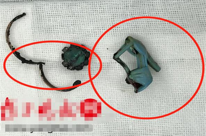 6岁女孩下身有异味，医生取出“异物”，父母：这到底是什么啊