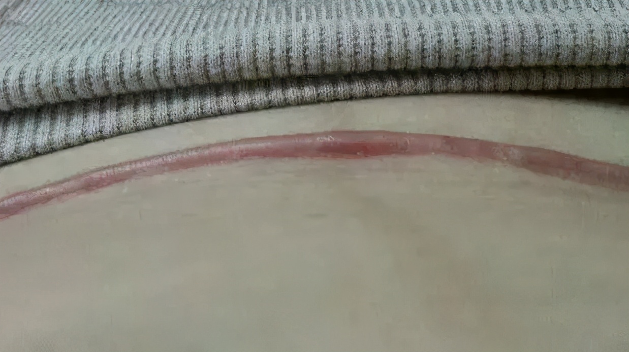 剖宫产如何才能让伤口愈合不留疤,剖宫产一年后的疤痕图片