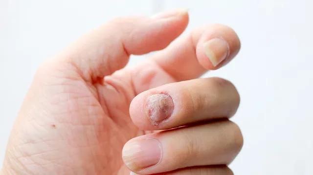 想治好灰指甲是不是需要先治脚癣,怎样治好灰指甲在家里