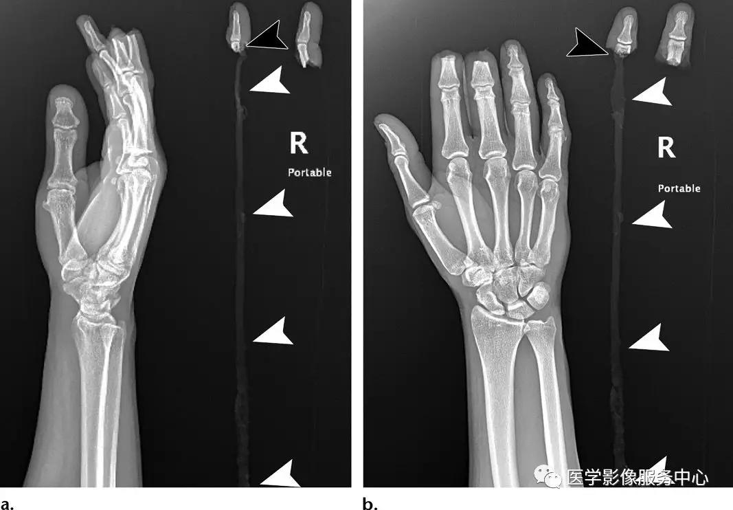 手腕撕脱性骨折一年了还隐隐作痛,手腕三角骨撕脱骨折症状有哪些