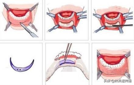 导致下巴歪的原因有哪些,下巴后缩严重的案例