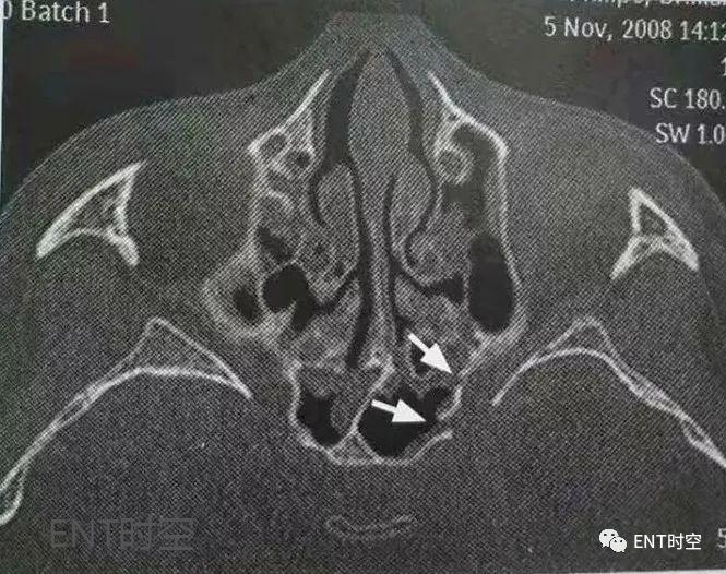 医学影像学解剖鼻骨,医学影像骨折