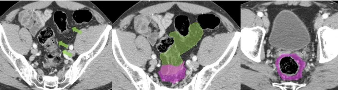 这样的解剖结构容易忘？重新认识肠系膜