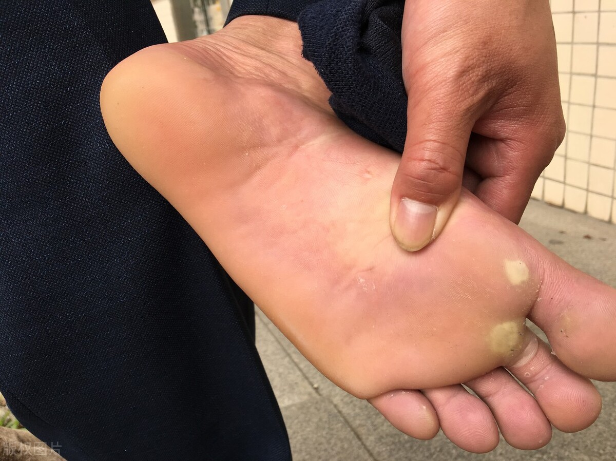 治老茧鸡眼跖疣最好的药,脚底长了一个像茧一样的东西跖疣