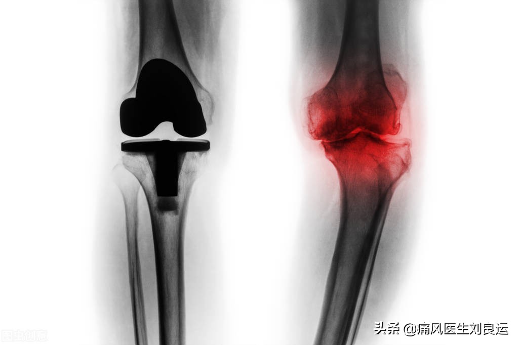 痛风发作大脚趾不能活动,痛风发作时只痛不肿不热为什么