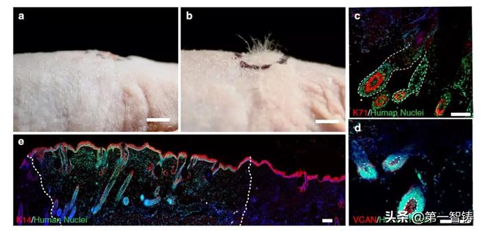3d打印毛囊成功视频,3d打印治疗脱发