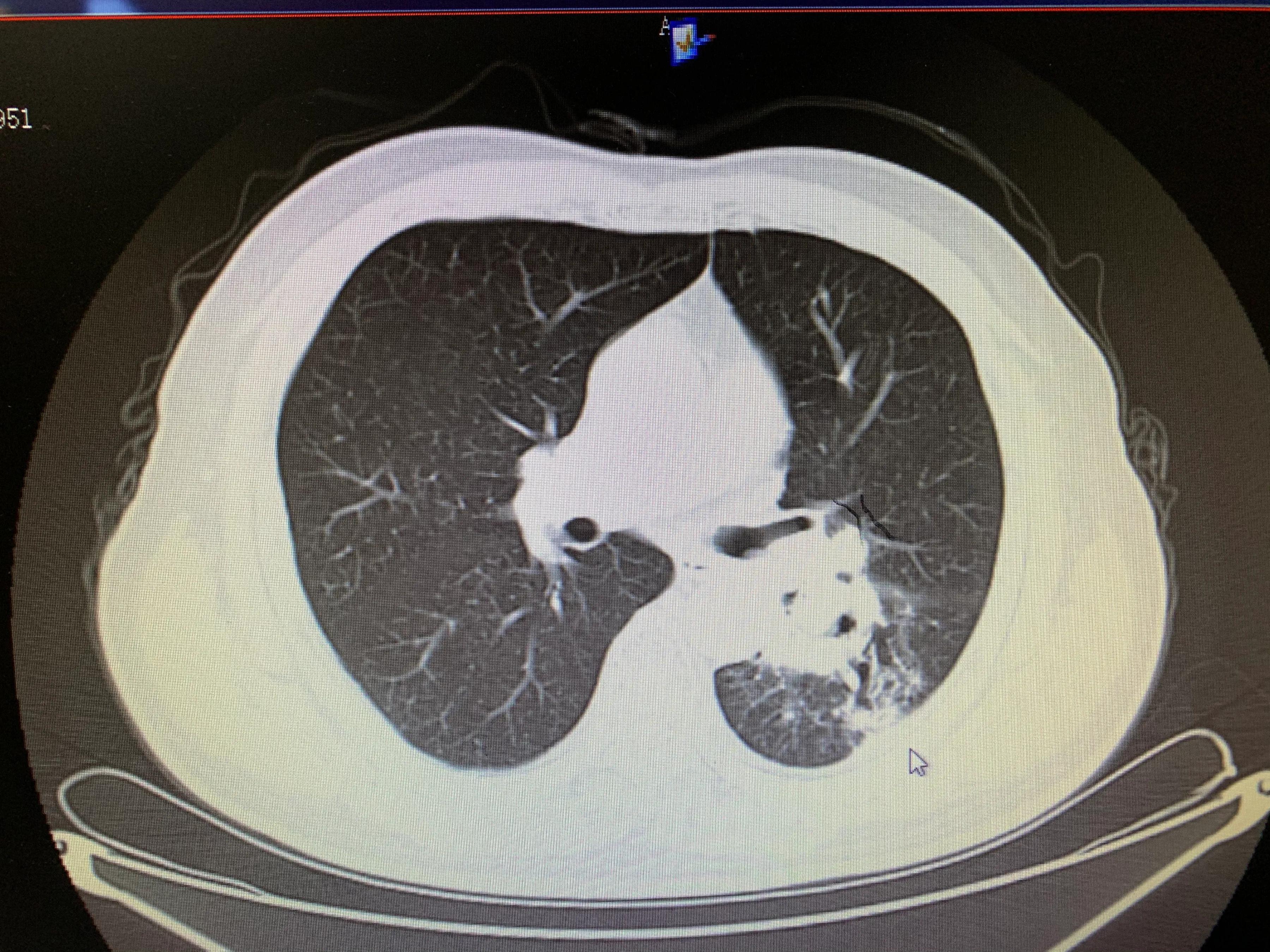 肺癌栓塞的介入治疗,84岁老人患肺癌可以做微创介入吗