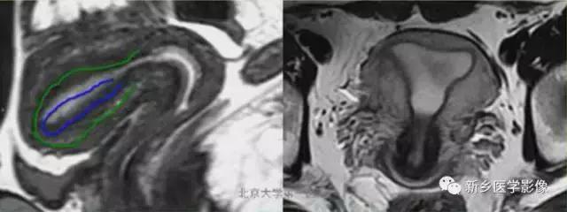 子宫发育异常，应想到的6大类常见畸形