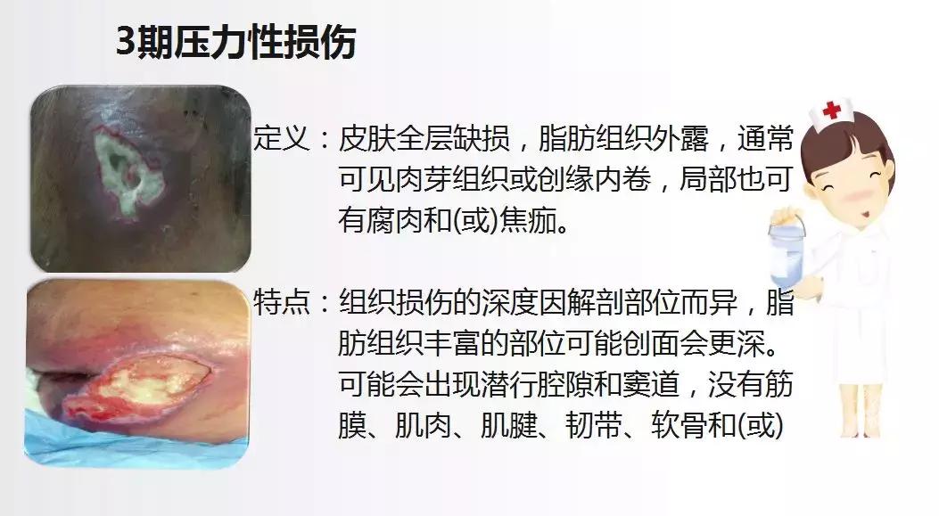 面对压疮不要慌,护理小妙招帮你忙!