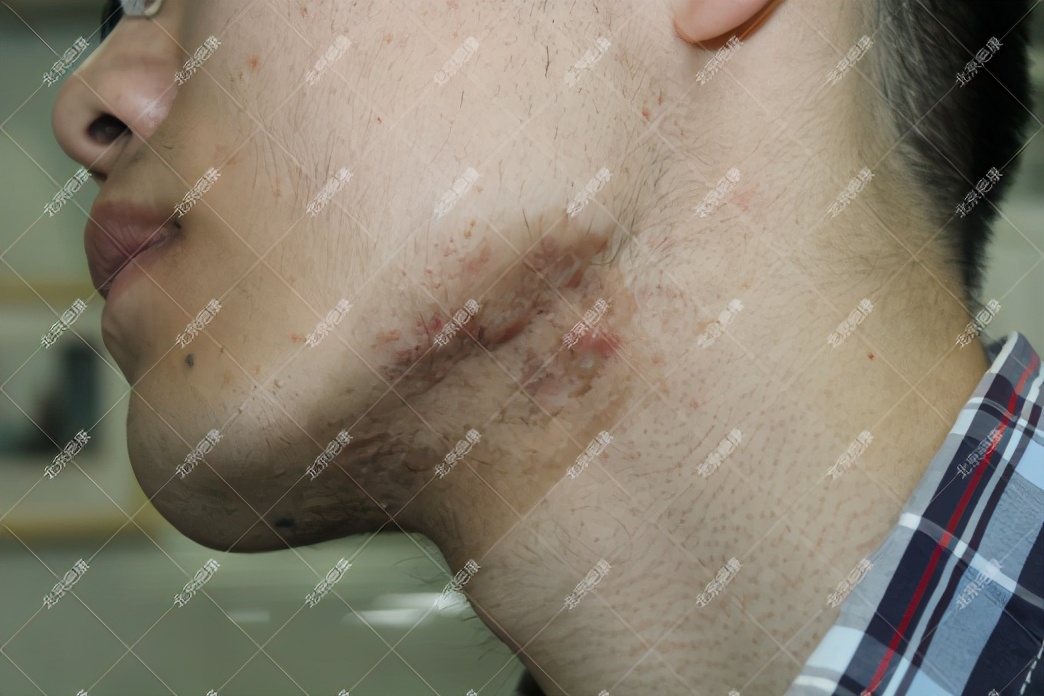 疤康治疤痕疙瘩靠谱吗,瘢痕疙瘩用疤克管用吗