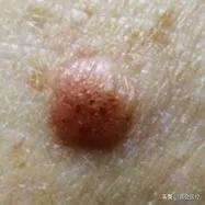 身上有个肿瘤要切除吗,怀疑其他部位有肿瘤需要怎么检查