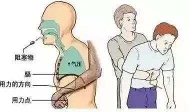 小孩先天性食道被塞什么引起的,一岁女童胃部被撑破