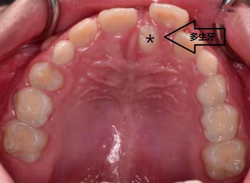门牙中间为什么有缝,门牙中间有缝预示什么