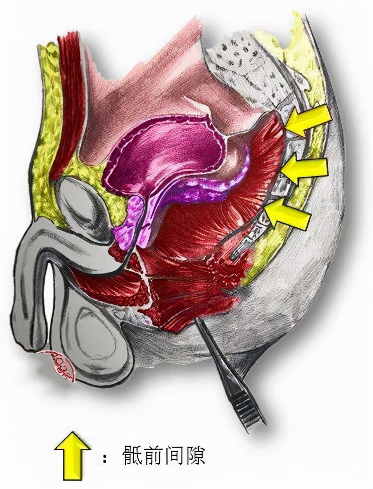 臀部长了一个瘤子是怎么回事,臀部上长个瘤子不疼不痒软软的