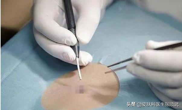 生下来特别小的痣长大变得很大,生下来就有的痣越长越大