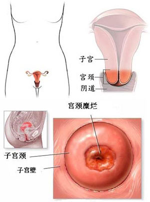 宫颈癌变的根源,宫颈腺体感染癌变