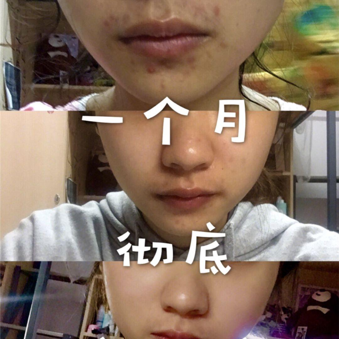 超好用的祛痘膏便宜,有没有好用的祛痘膏推荐女孩子