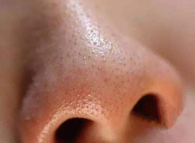 头皮痒头屑多是脂溢性皮炎,头皮油又痒头皮屑多是怎么回事