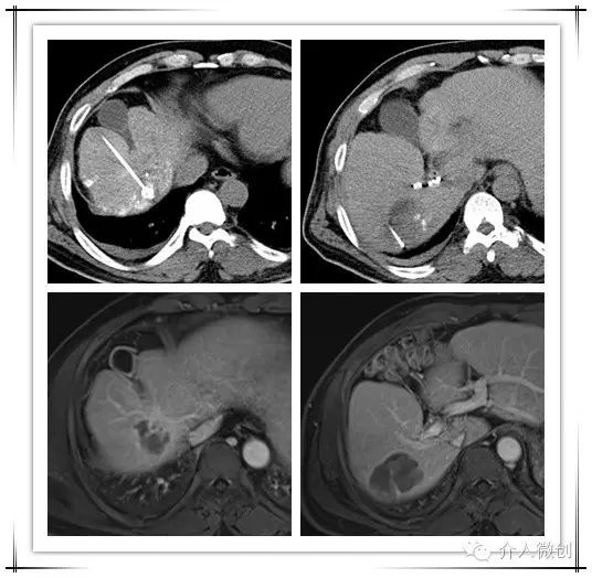 原发性肝癌伴门静脉癌栓能活多久,原发性肝癌介入治疗及进展