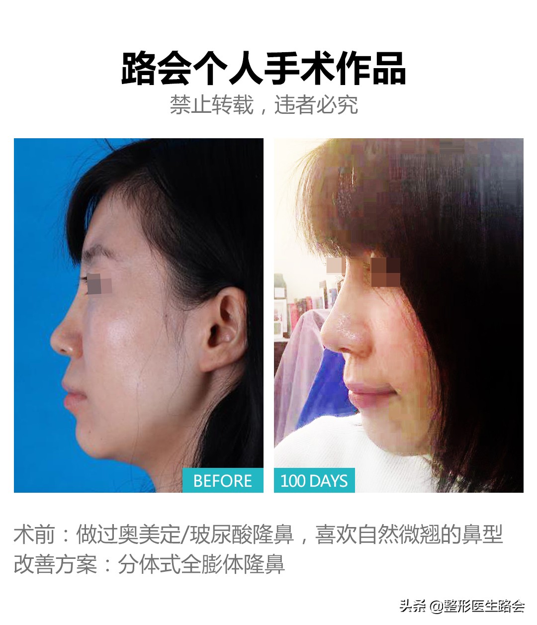 膨体隆鼻很假吗,膨体隆鼻假不假