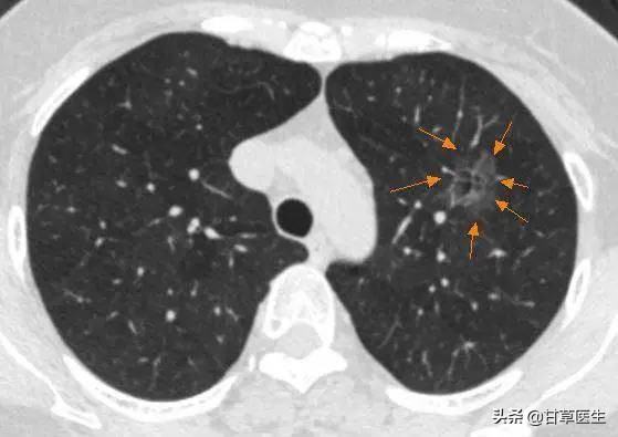发现硬块是什么原因,发现包块是癌症晚期吗