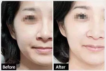 哪种果酸治闭口最好用,什么果酸对闭口有用