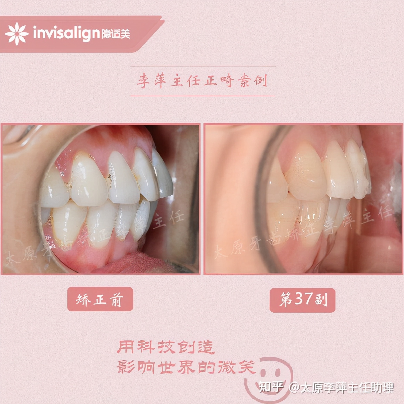 太原牙齿矫正靠谱吗,太原成人隐形牙套牙齿不齐
