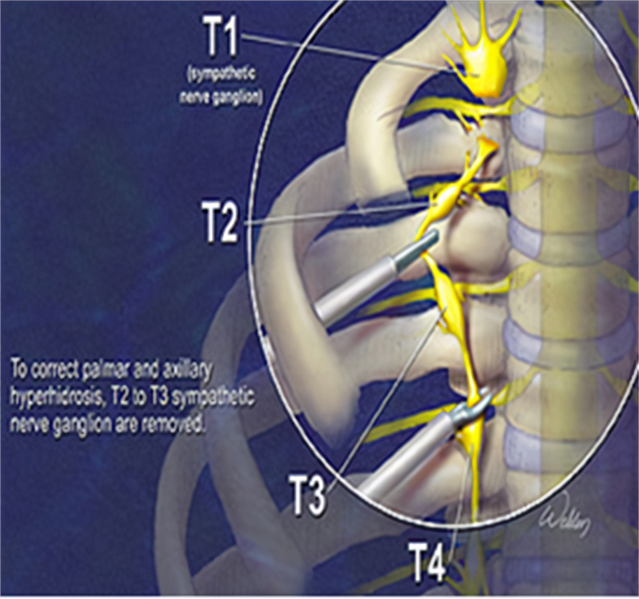 汗手症怎么治疗最有效,治疗手汗症保守的方法