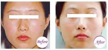 755激光祛斑和其他激光有什么区别,祛斑后反黑后可以再次激光祛斑吗