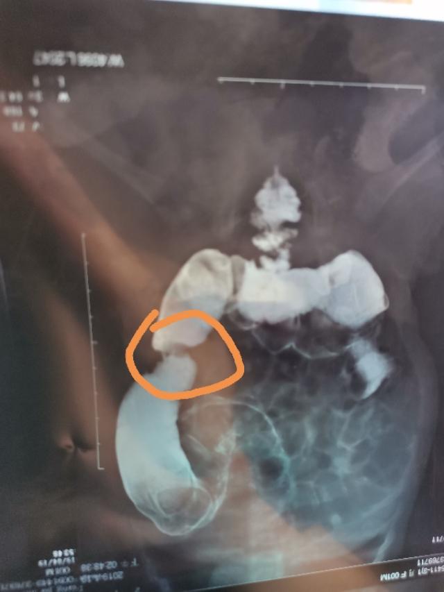 便秘严重需要动手术吗,一岁宝宝长期便秘需要检查什么