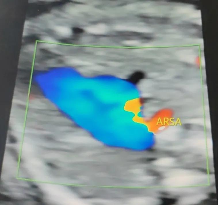 胎儿右锁骨下动脉迷走是心脏病吗,胎儿右锁骨下动脉迷走要做无创吗