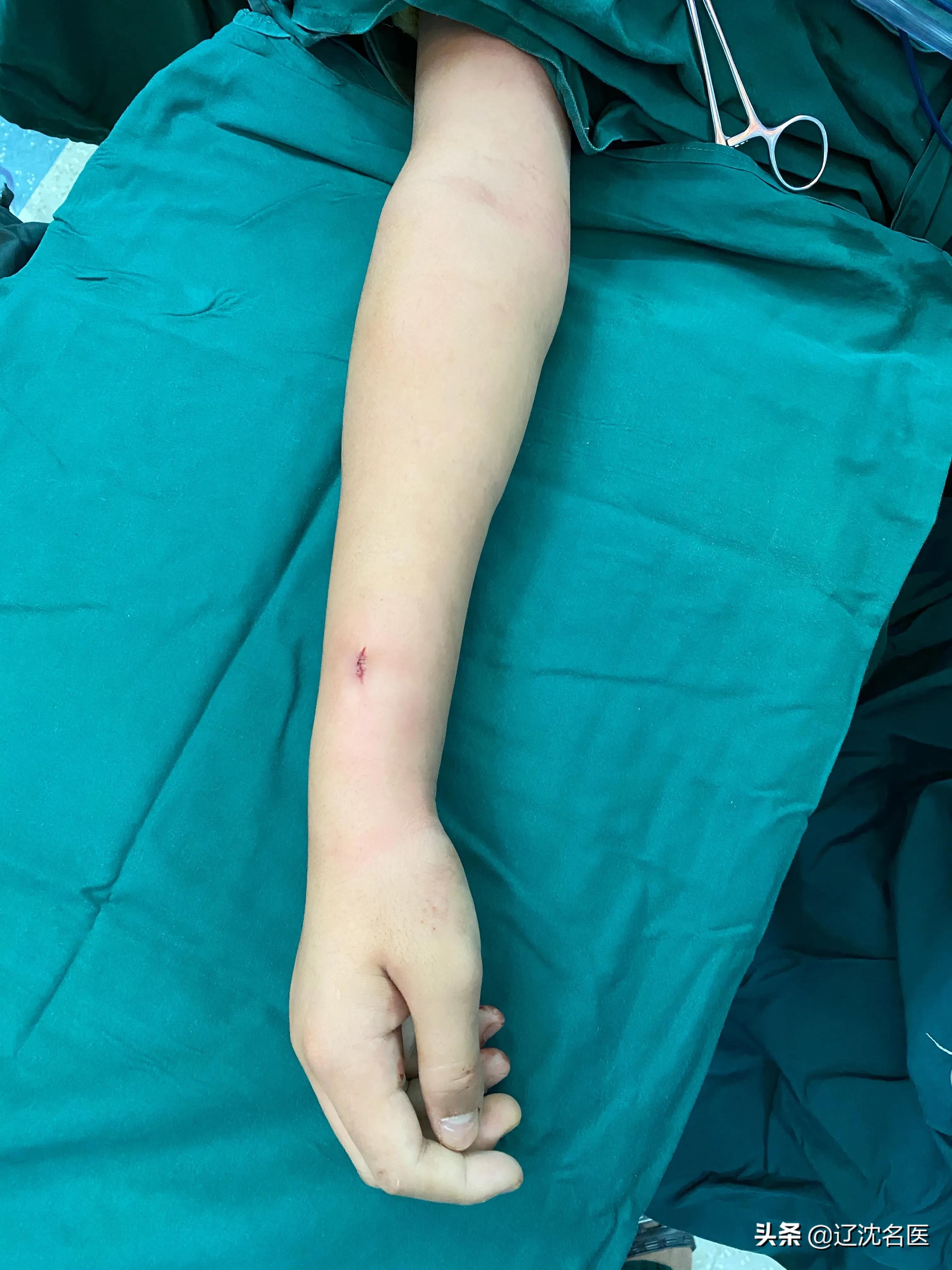 儿童尺桡骨双骨折保守治疗后错位,六岁儿童桡骨颈骨骨折多久恢复