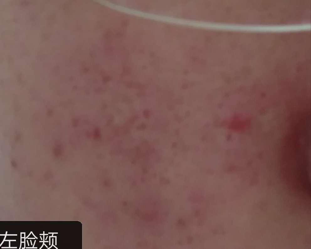 30多岁了脸上还是长痘痘反反复复,脸上反反复复长痘痘是怎么回事