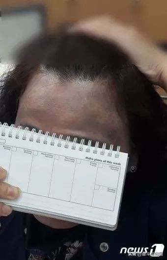 太惨了!这起染发*案惨**在韩国又双叒发生了