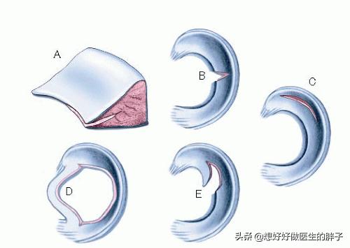 半月板撕裂手术后怎么自己做康复,半月板撕裂手术最佳自愈方法