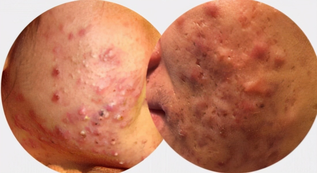 痛风的基础知识及用药,痛风各期用药攻略